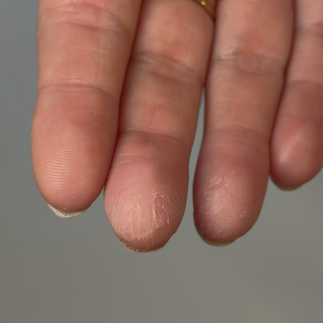 Why Am I Suddenly Allergic to Gel Nails? Navy’s Guide to Nail Health